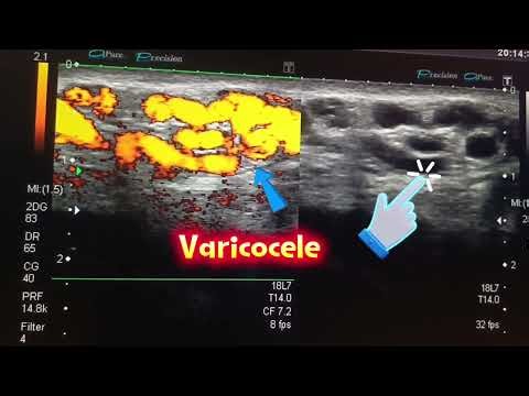 Ultrasound for Varicocele | Testicular Scan | Ultrasound Scrotum