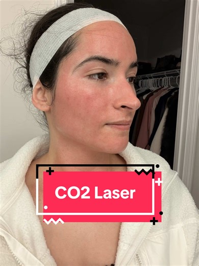 CO2 Laser Skin Resurfacing Results and Experience