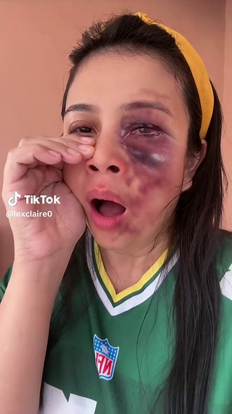 Effective Wound Care for Facial Bruises