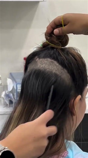 Female Hair Transplant Explained | Who Needs It, Results & Safety