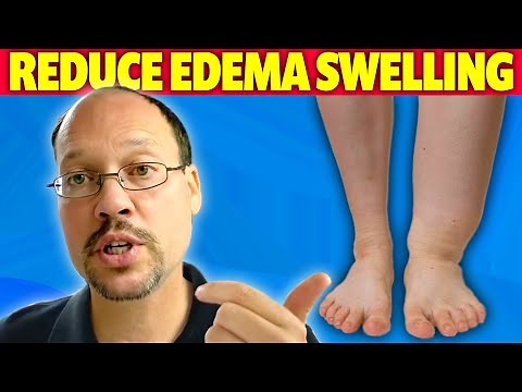 Swelling (Edema) In Ankles And Kidney Disease. 3 Tips For Improving It