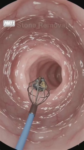 Laser Kidney Stone Removal Procedure | Ureteroscopy#facts #ai #science #ureteral