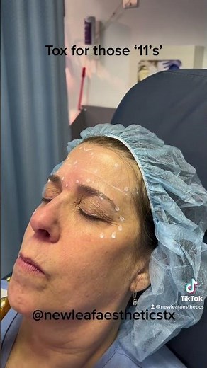 Glabella (11's) Tox Treatment Demonstration (Xeomin)