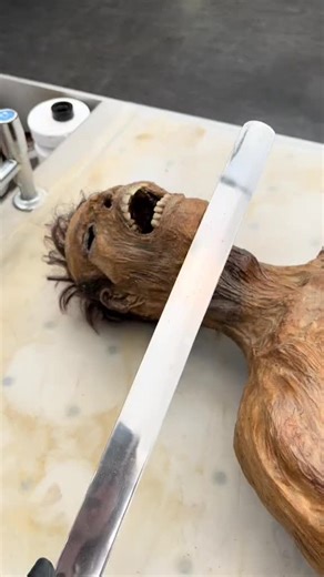 Transforming Lives with Custom Prosthetics