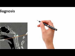 Basiliar Invagination|Medicine classroom