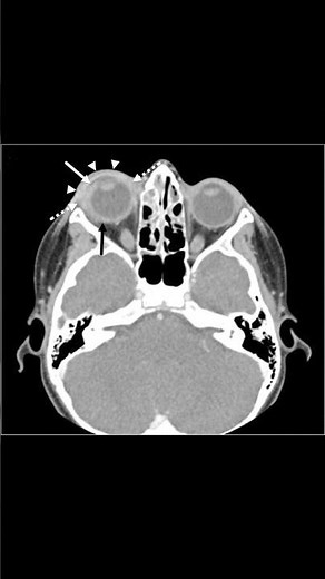 Orbital Cellulitis #meded #ophthalmology #emergencymedicine #infectiousdiseases #radiology