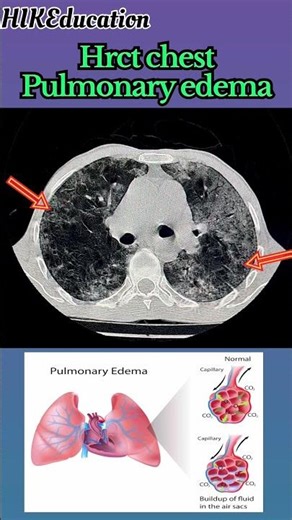 Hrct chest / pulmonary edema / cect chest / ct thorax / ct chest