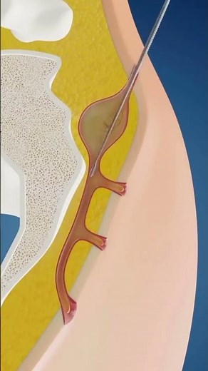 Silac(sinus laser ablation of pilonidal cyst ) procedure #surgery#medical #surgeon #procedure #mbbs