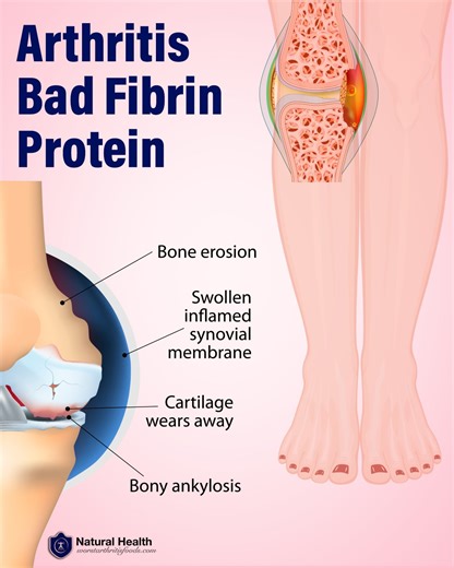 The Sticky “Glue” Protein Fibrin is a sticky protein accumulating inside the body's joints that may cause arthritis pain and stiffness - as well as other health issues. Here is why fibrin matters and how to deal with it: https://go.worstarthritisfoods.com/spFibrin | Healthy Back Institute
