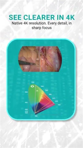 Future of Minimally Invasive Surgery | SonoScape 4K 3D Laparoscopic MIS System #shorts
