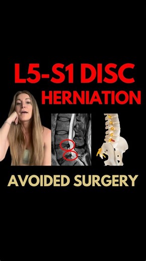 6.3K views · 16 reactions | L5-S1 Disc Herniation 100% Recovery ✅...