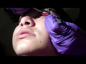 Sty Removal (chalazion)