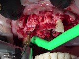 Teeth Extraction with Immediate Implants Placement • Video • MEDtube.net