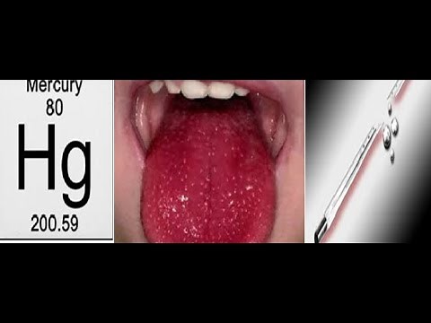 Mercury Poisoning and management by MSR