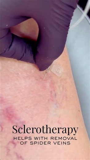 Sclerotherapy | Spider Veins Removal