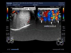 Ultrasound Video showing varicocele.