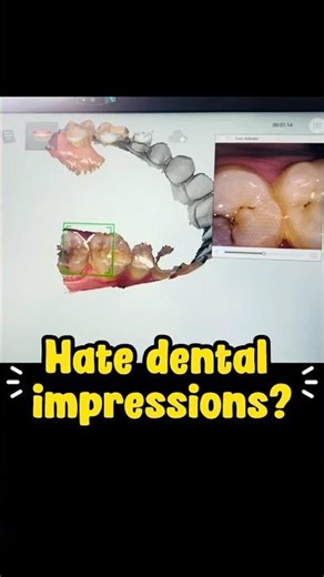 Hate Impressions? Digital Scan for Clear Aligners