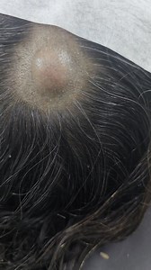 Scalp Dermoid | Dr Khaled's Tumour Helpline