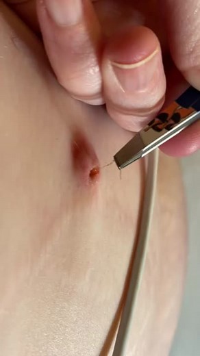 #spotsextraction #satisfying #extractions #blackhead #blackheadsremoval #satisfyingvideo #satisfy #satisfyingvideos #spots #wap #asmr #love #loveyou #fyp #foryou #foryourpage #acne #acneshot #cyst #cystpopping #pimple #pop