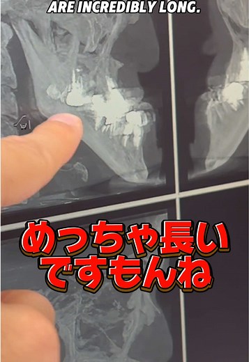驚きの顎レントゲン結果を公開