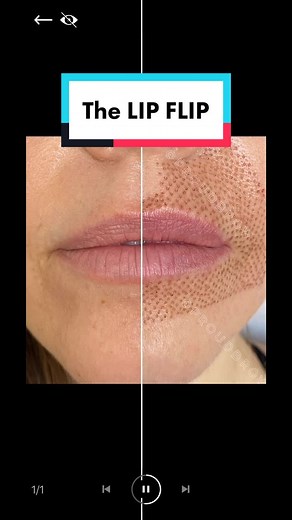 #zerofillers #asymmetrycorrecrion #plasmalift #plasmafibroblast #plasmalifting #fibroblastplasma #fibroblasting @proudbrow on #Instagram for more