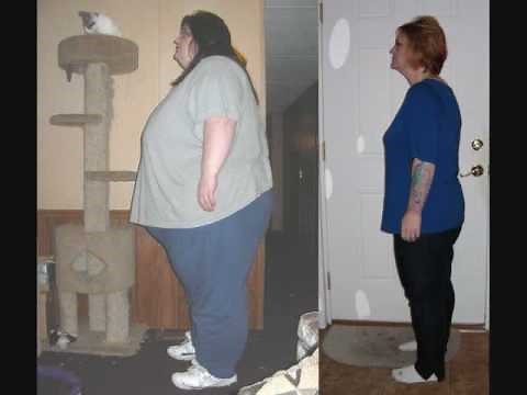 Before and After Lapband 20 Months Post-Op