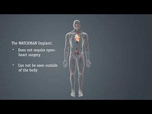 Cardiovascular WATCHMAN™ to Reduce AFib Stroke Risk