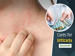 Here's Everything You Need To Know About Urticaria, Symptoms, Causes And Treatment