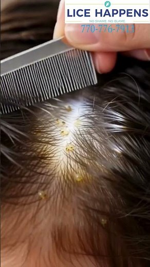 How to Spot Head Lice Early & Stop It Fast | Quick Lice Check Guide
