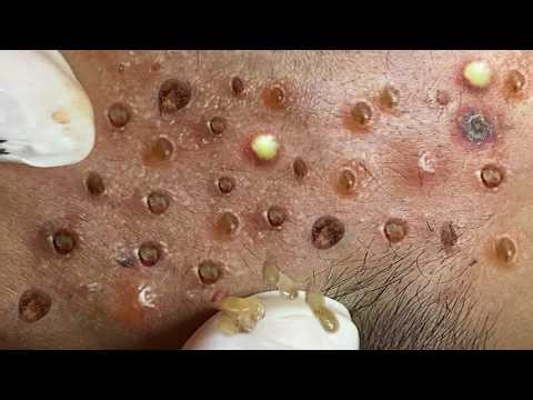 Loan Nguyen Acne Treatment 24tt