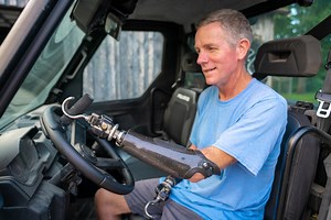 Driving After Upper Limb Loss
