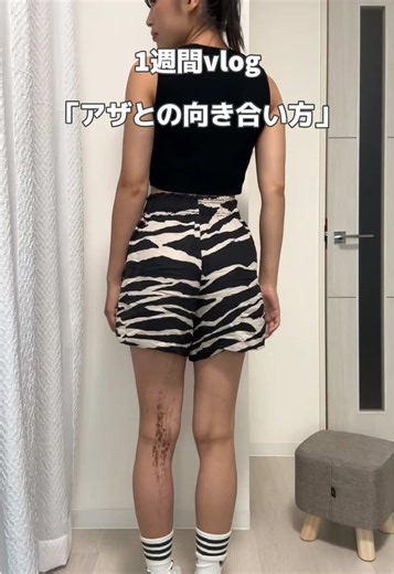 アザを理由で何かを諦めることはもうしないって決めたの。 #おすすめ#fyp #03 #皮膚管理 #マインド