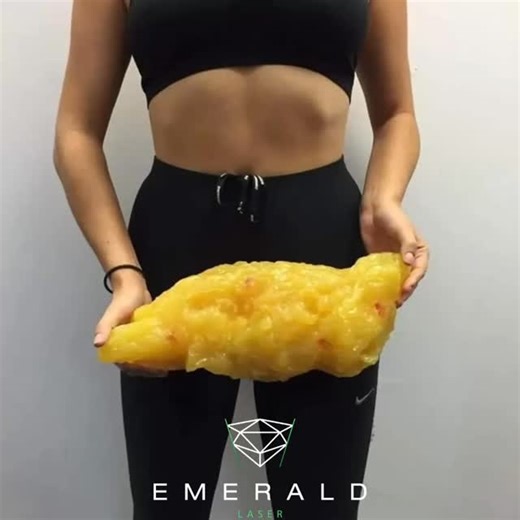 💚 Emerald Laser — the effortless fat loss treatment everyone’s talking about. No pain. No heat. No downtime. Just real, measurable results. ✨ The Emerald Laser is FDA-approved for overall fat reduction and works by targeting fat cells directly — creating tiny pores that allow stored fat to be released and naturally flushed out through your lymphatic system 💧 This means it helps your body eliminate fat in a natural, healthy way — while also improving circulation and lymphatic flow. Clients are 
