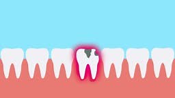 Rotten dead tooth hurting and giving a red pain signal 4K animation....