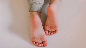 COVID toes: a new mysterious skin condition possibly linked to coronavirus