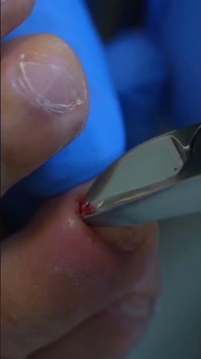 Cutting and fixing an ingrown toenail. #ingrown_toenail #ingrown_toenail_surgery