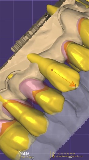 #dentallab #digitalsmile #dentaldesign #cadcamdentistry #exocad #design #dentalimplant