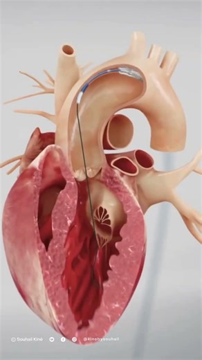 Stent dans une artère explication en 30 secondes