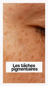 Le lentigo ou les taches pigmentaires ! | Docteur Michel Boksenbaum - Médecine esthétique