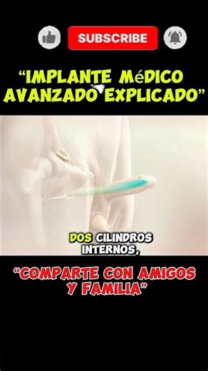 “Implante médico avanzado explicado en 60 segundos”