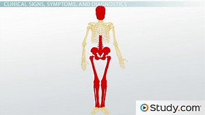 Paget's Disease of Bone: Causes, Symptoms & Treatments