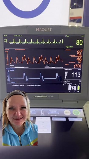 IABP - this is showing the IABP in a 1:3 ratio. ❤️ The main benefits of IABP therapy are afterload reduction & coronary perfusion. Ideally the assisted systole & assisted diastole are reduced at least 3-5 mmHg or so compared to the unassisted systolic & diastolic pressures. #criticalcare #criticalcarenurse #emergency #emergencynurse #telemetry #progressivecare #nurse #nursingstudent #nurselife #telemetrynurse #progressivecarenurse #iabp #cardiogenicshock #cardiac #cardiology