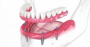 Prostheses supported by 4 implants. Dental 3D animation