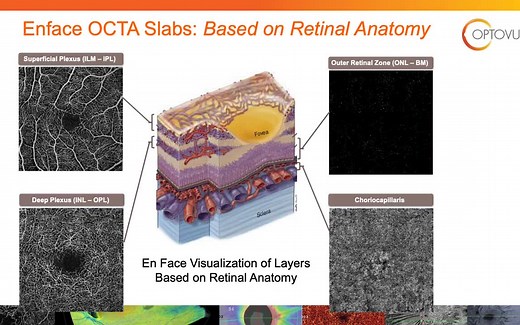 【中英双字】【OCTA简介】【OCT血管造影】Introduction to OCT Angiography