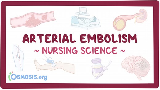 Arterial embolism: Nursing: Video & Causes | Osmosis