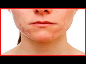 Acné conglobata : causes et symptômes