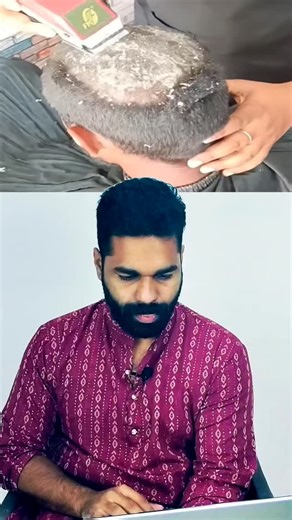 DrBinil Balakrishnan on Instagram: "Dandruff isn’t just dry scalp—it’s often a fungal imbalance. Malassezia furfur thrives in cold climates, high sugar diets, and low immunity. Ayurveda sees this as a sign of internal ama. Virchana (therapeutic purgation) cleanses the root, while taila application and anti-dandruff shampoo soothe externally. Treatment must be personalized—because your scalp tells your story." #AyurvedaForScalp #MalasseziaFurfur #VirchanaHealing #DandruffAwareness #TailaTherapy #