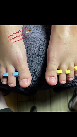 Prosthetic Toenail Reconstruction with LCN Barefoot Gel