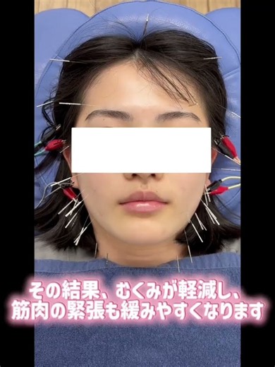 美容鍼でこんなに変わるの？