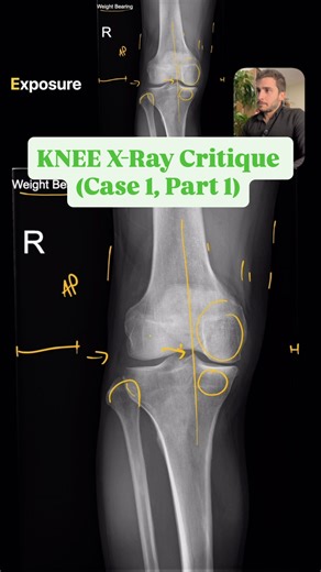 Dr. Sahand Hooshmand on Instagram: "Position, Area, Collimation, and Exposure critique for a KNEE X-Ray #radiography #medicalimaging #xray #critique #knee"